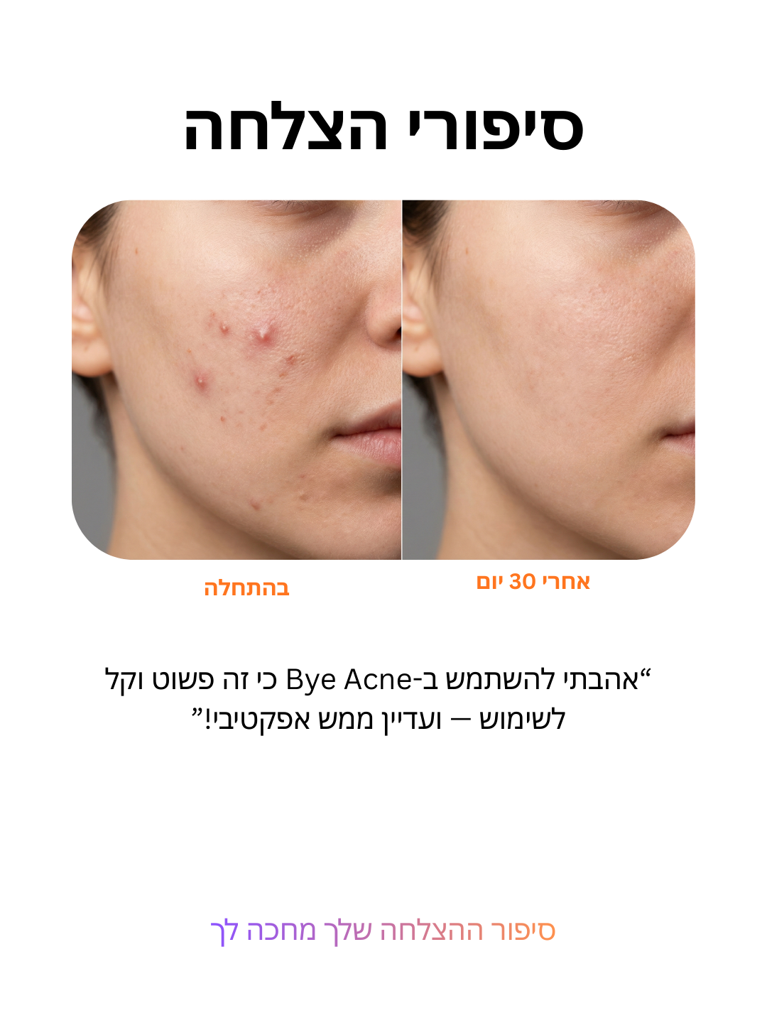 ביי אקנה: טיפול בפצעונים ב-3 דקות