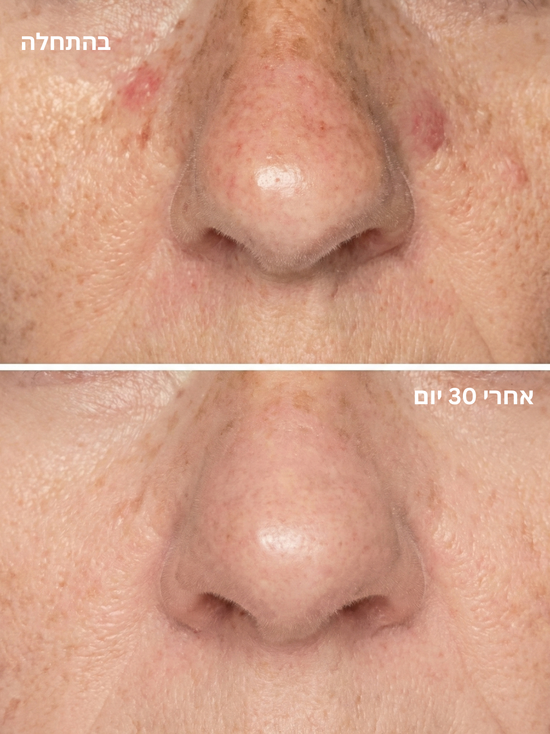 מסכת פנים לד לטיפול אנטי אייג'ינג