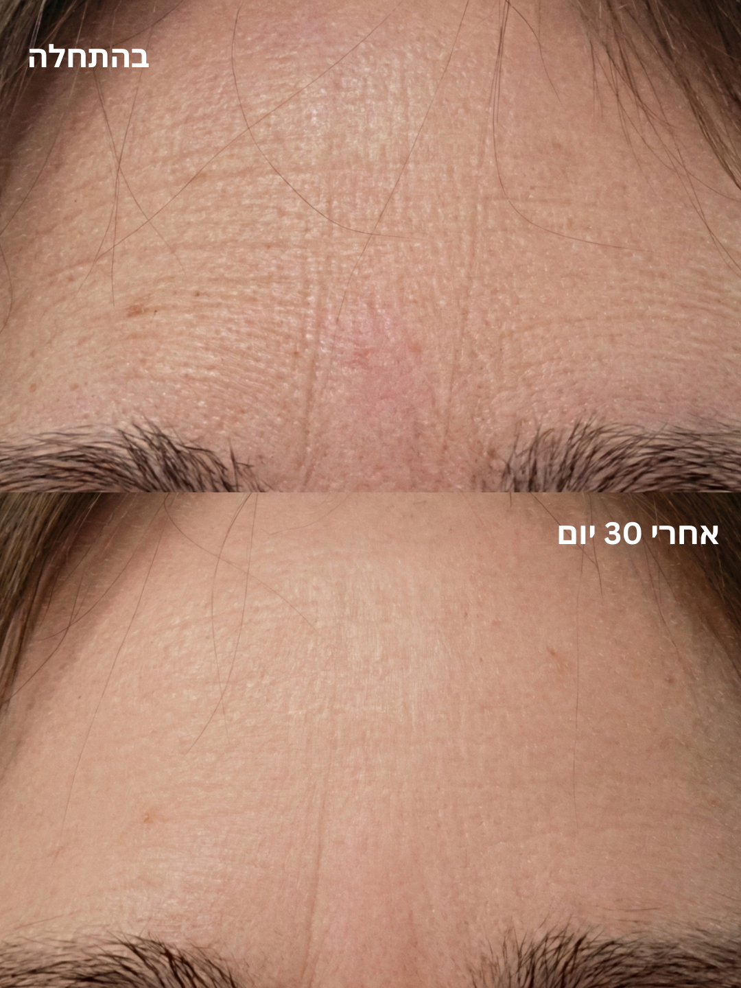 מסכת פנים לד לטיפול אנטי אייג'ינג