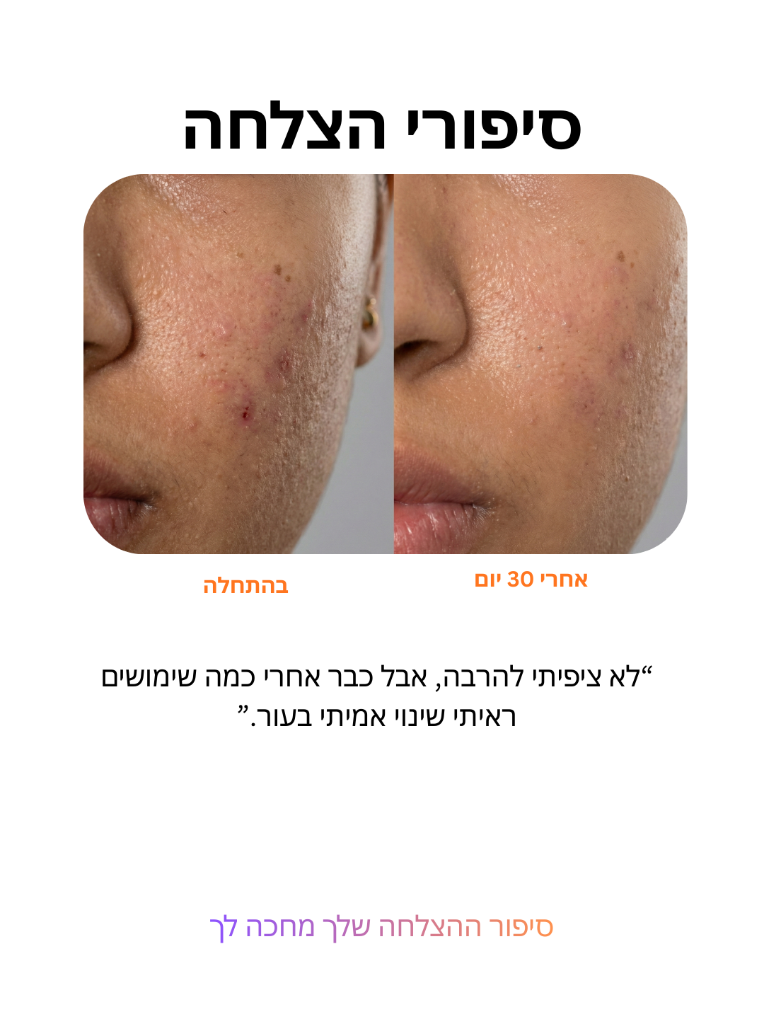 ביי אקנה: טיפול בפצעונים ב-3 דקות