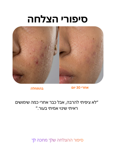 ביי אקנה: טיפול בפצעונים ב-3 דקות