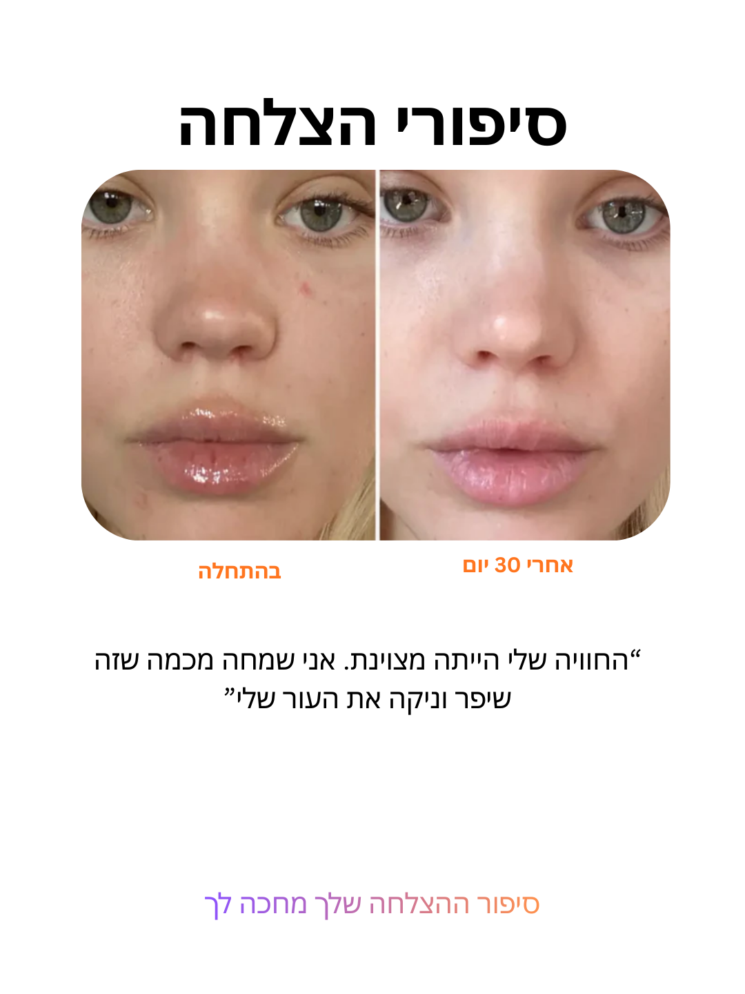 ביי אקנה: טיפול בפצעונים ב-3 דקות